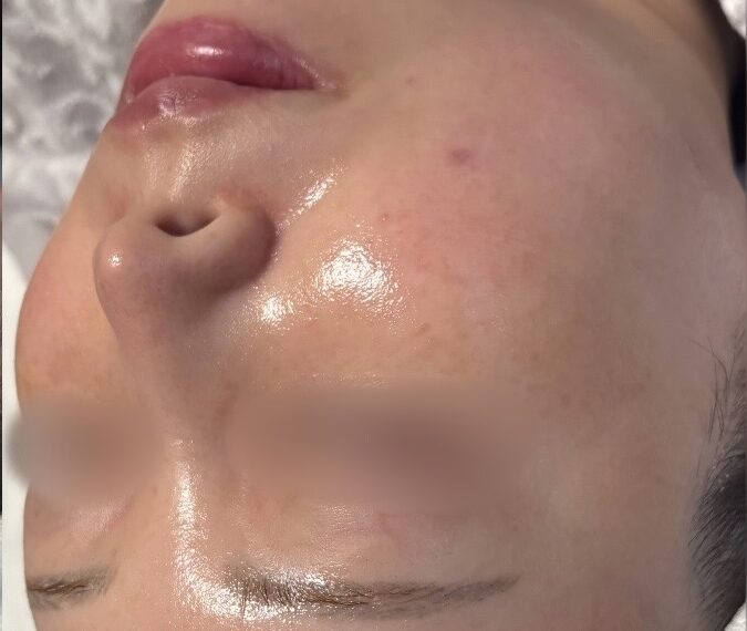 テカり・皮脂バランスケア Before / After 施術後（After）