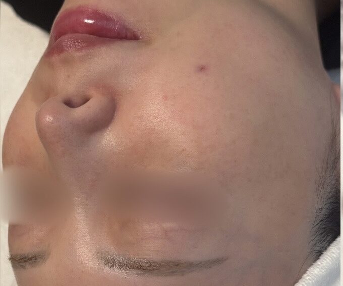 テカり・皮脂バランスケア Before / After 施術前（Before）