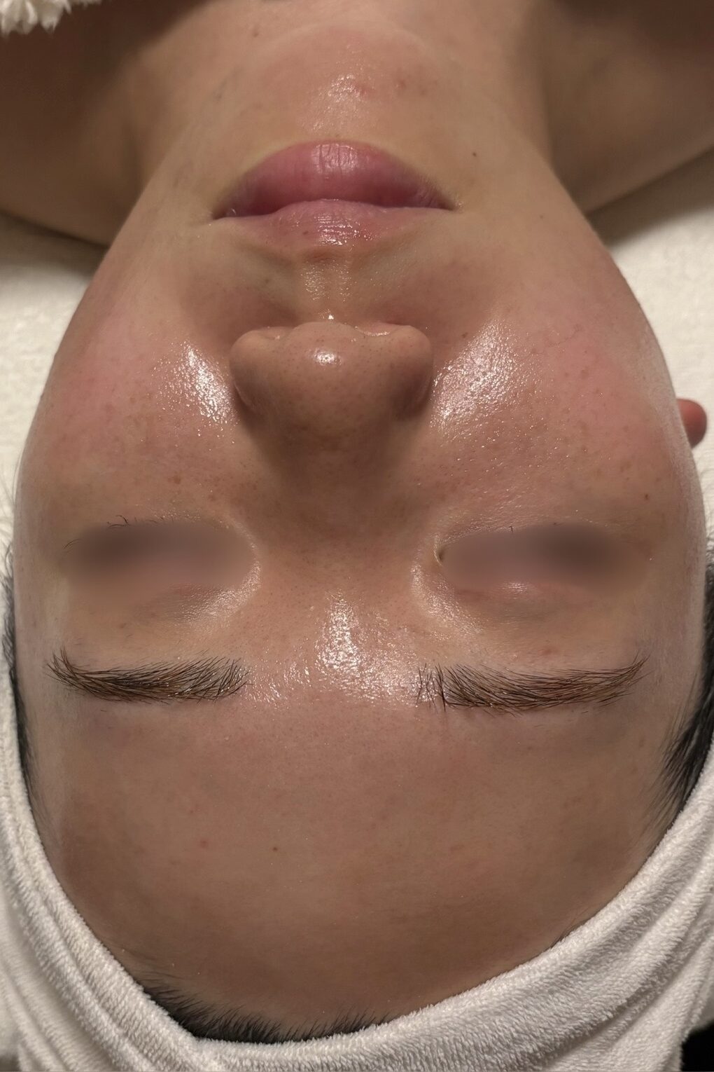 毛穴・黒ずみ・くすみ肌ケア Before / After 施術後（After）